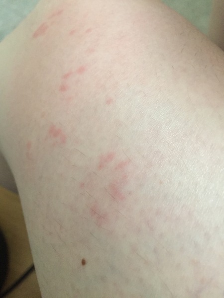 Anyone know what this is on my leg?!