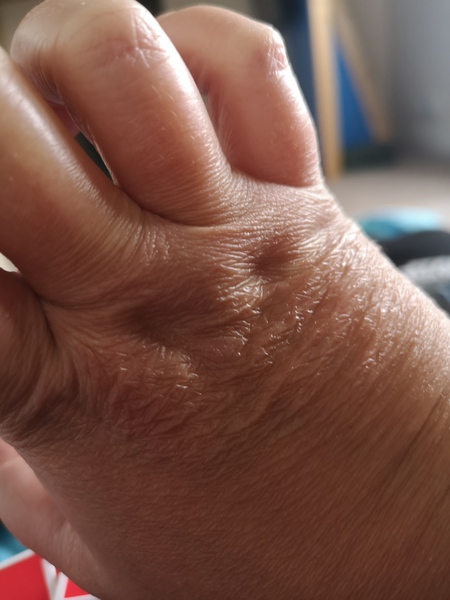 Why are my hands ageing so quickly?