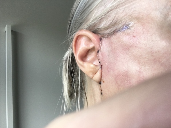 My droopy jowl mini face lift result pics