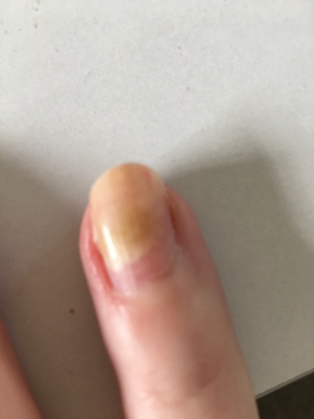 Nail is white and very brittle - what could it be? (Photo)
