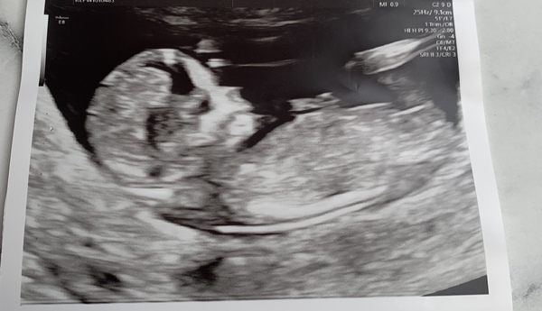 Just for fun - gender guess 12 week scan