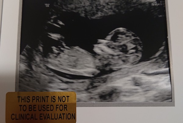 12 week scan nerves