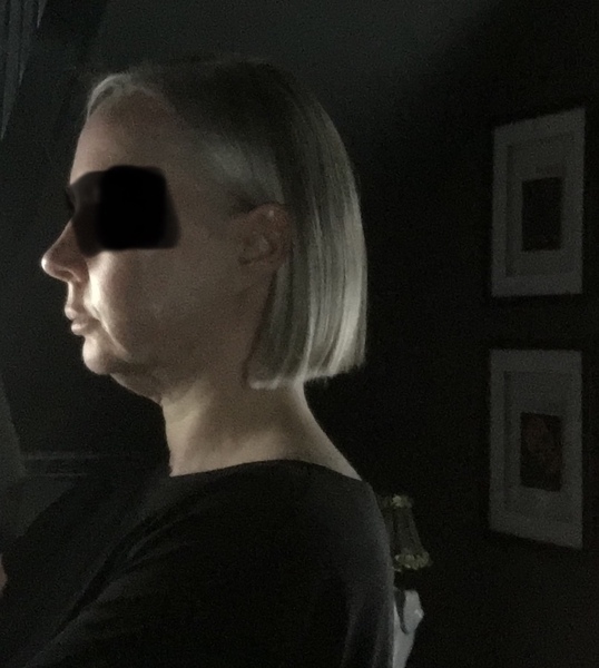 My droopy jowl mini face lift result pics