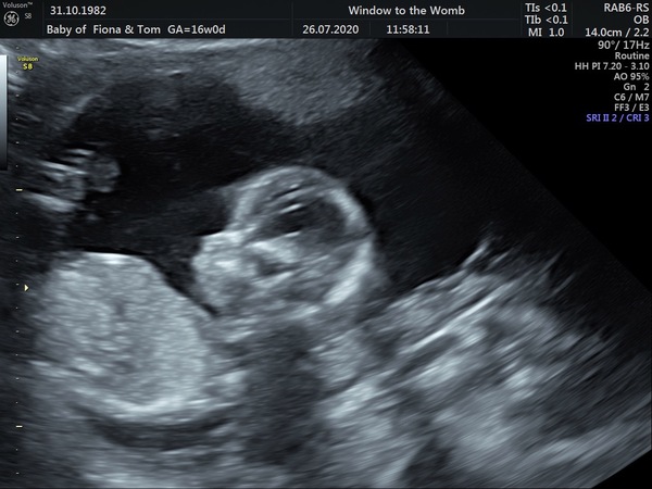 Catching up - TTC after miscarriage part 2