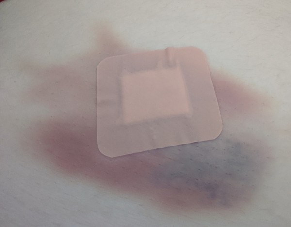 CVS testing during pregnancy - who has had it? Big bruise!