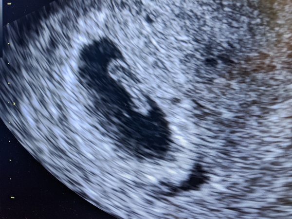 Pregnant after Missed Miscarriage MMC