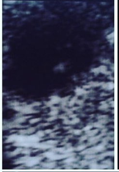Empty gestational sac
