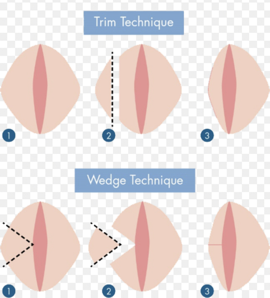 I’ve had labiaplasty.