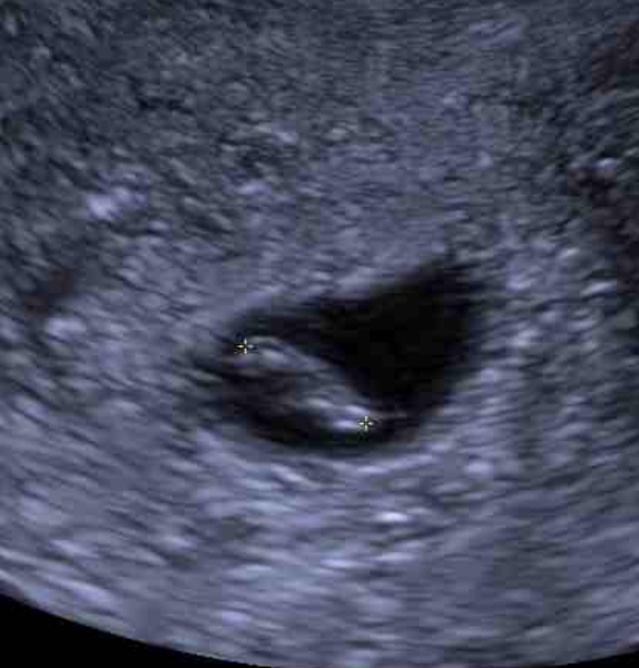 Pregnancy after MMC