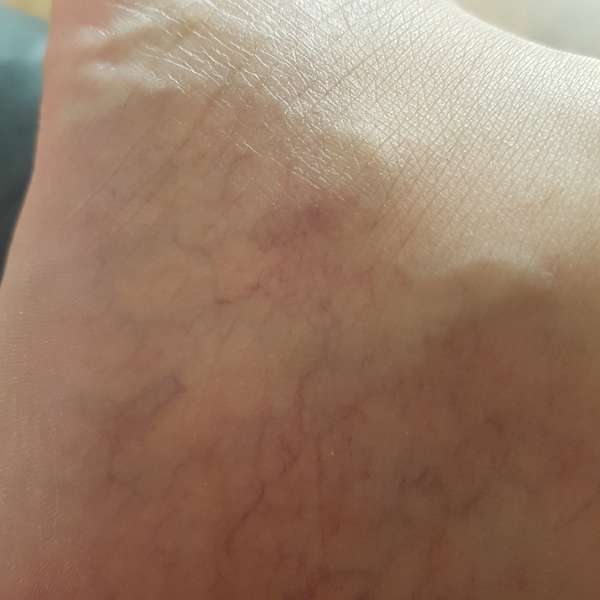 What’s up with my vein?