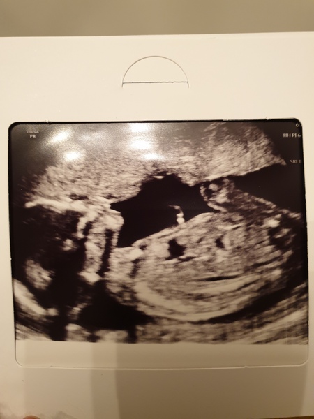 👣 Due Nov/Dec 👣 it's the 20 week scans! 👣