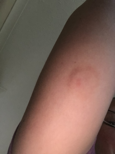 Insect bite???