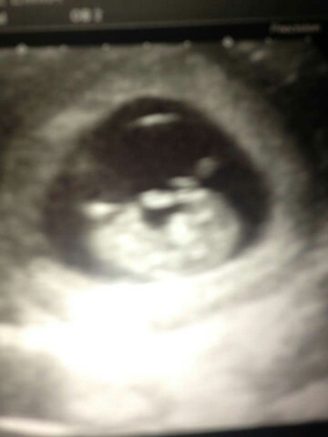 Pregnant after Missed Miscarriage MMC
