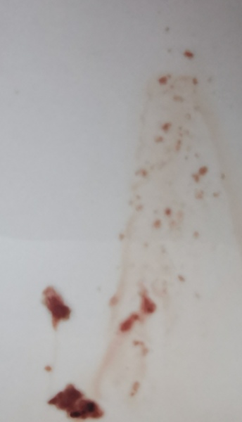 Bleeding in early pregnancy HELP PLEASE