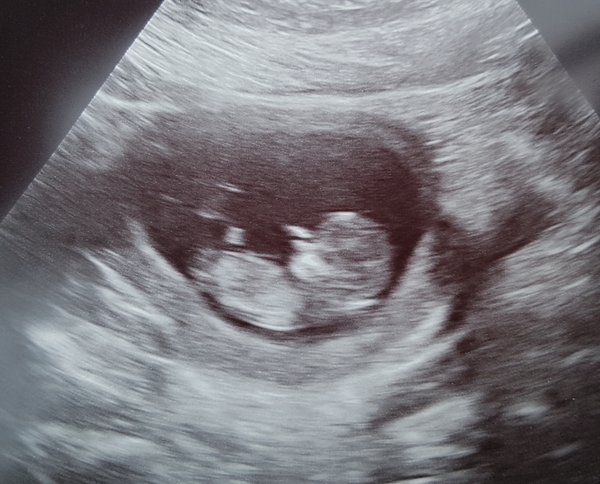 12W scan nub/skull theory guesses?