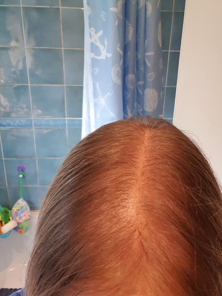 Thin Hair Help