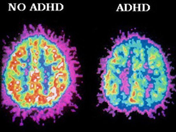 Do many people think that ADHD is not real?