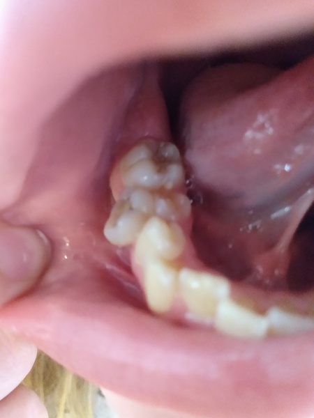 Warning - tooth close-up! Wobbly tooth sitting on gum, won't come out