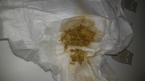 Help! Is this normal? (BABY POO)