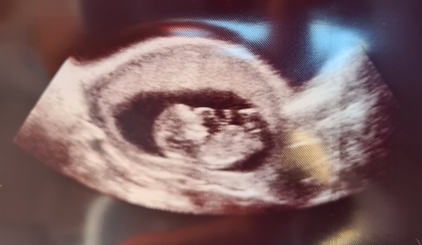 12 week scan nerves