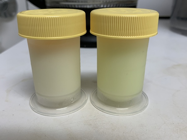 Bright yellow breastmilk from multivitamin.