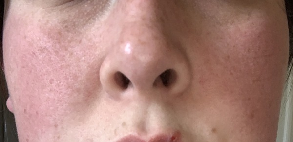 Rash on face