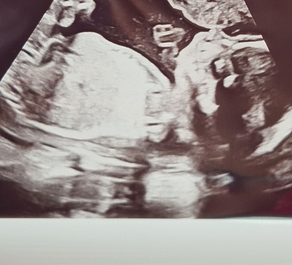 Skull theory...guesses 20 week