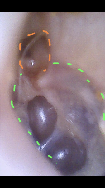 Sporn again! Bought a tiny camera to lol inside my ears and my eardrum looks really weird. Warning! Grim pics