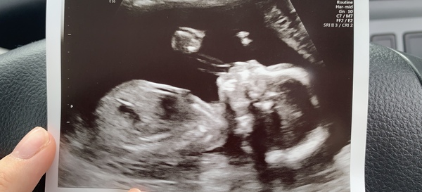 👣 Due Nov/Dec 👣 it's the 20 week scans! 👣