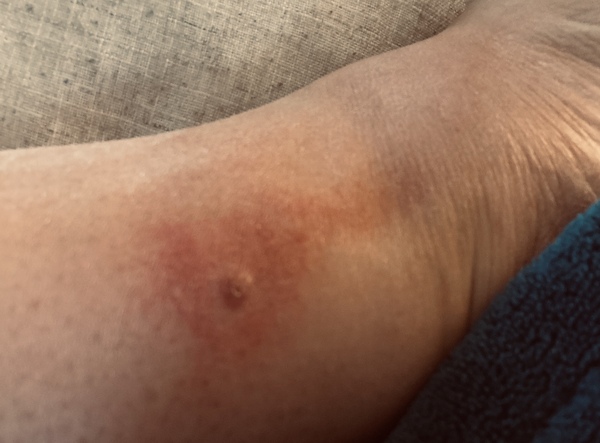 What has bitten me?