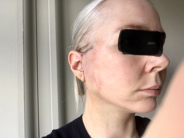 My droopy jowl mini face lift result pics
