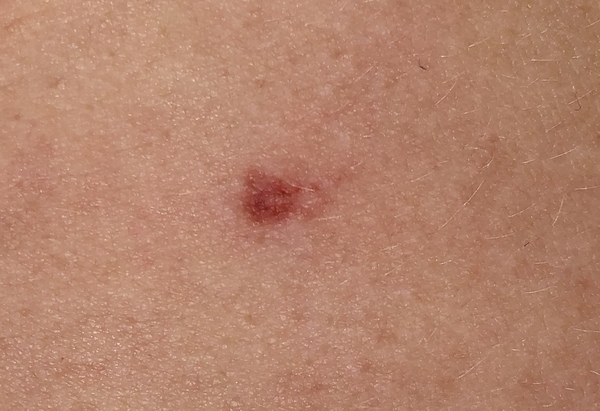 Bruise/Mark
