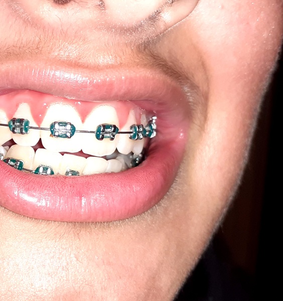Teen with braces just found a cavity