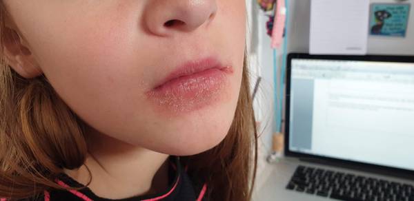 Red, flaky rash around DD's mouth