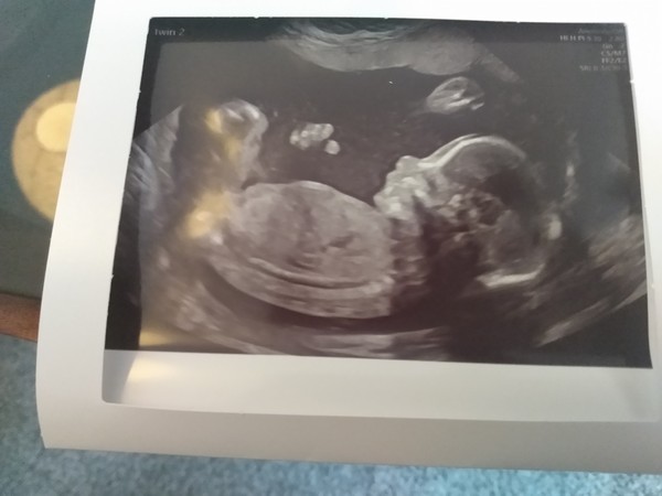 👣 Due Nov/Dec 👣 it's the 20 week scans! 👣