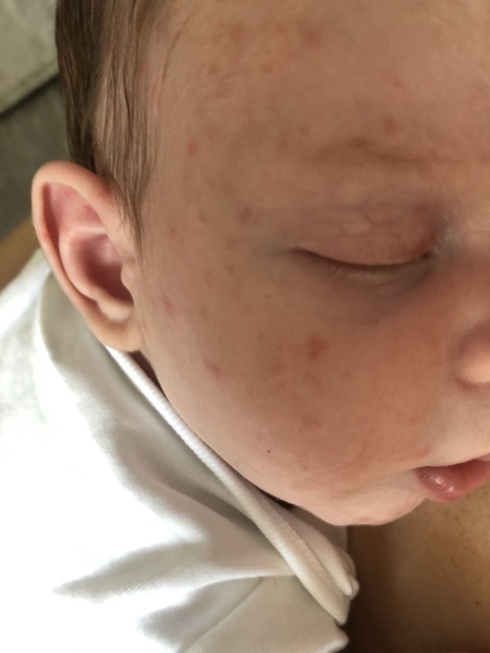 Newborn rash