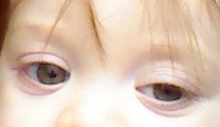 Toddler eyelid drooping/one eye bigger than the other. Should I be worried?