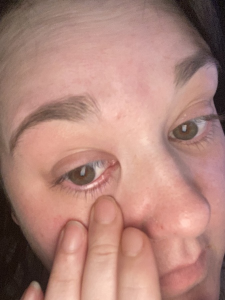 Stye?