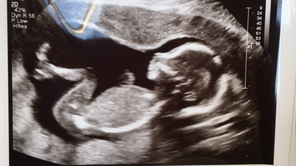 👣 Due Nov/Dec 👣 it's the 20 week scans! 👣