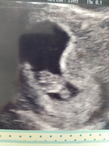 Yolk sac
