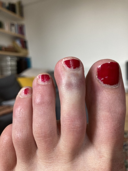 Have I broken my toe? With Pic