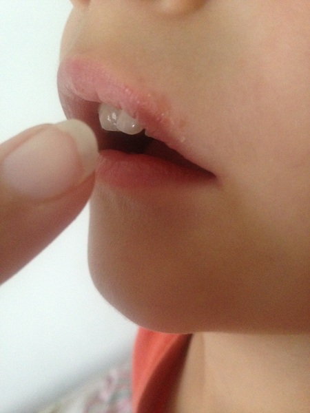 Cold sore? Impetigo? Reaction?
