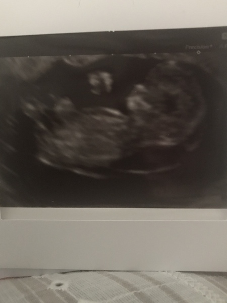 Fluid under baby skin 10 week scan, high risk.