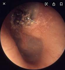 Sporn again! Bought a tiny camera to lol inside my ears and my eardrum looks really weird. Warning! Grim pics