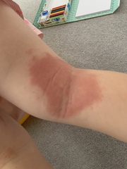 Eczema?