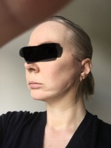 My droopy jowl mini face lift result pics