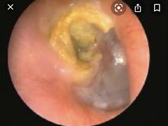Sporn again! Bought a tiny camera to lol inside my ears and my eardrum looks really weird. Warning! Grim pics