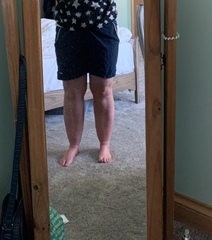 Can any one please advise on cankles :(