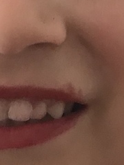 Cold sore? Impetigo? Reaction?