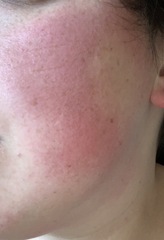 Rash on face